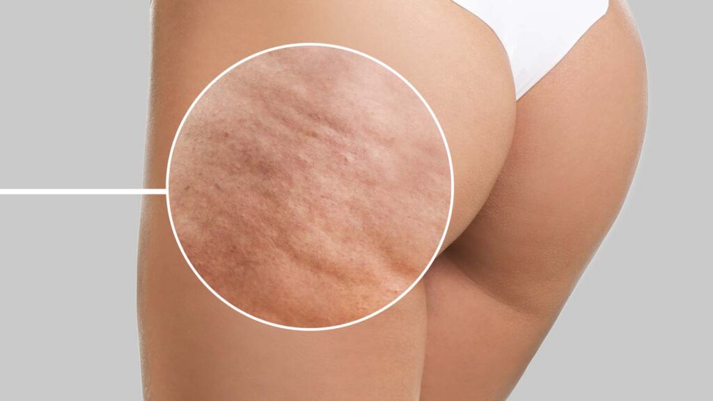 cellulite laser treatment stamford ct