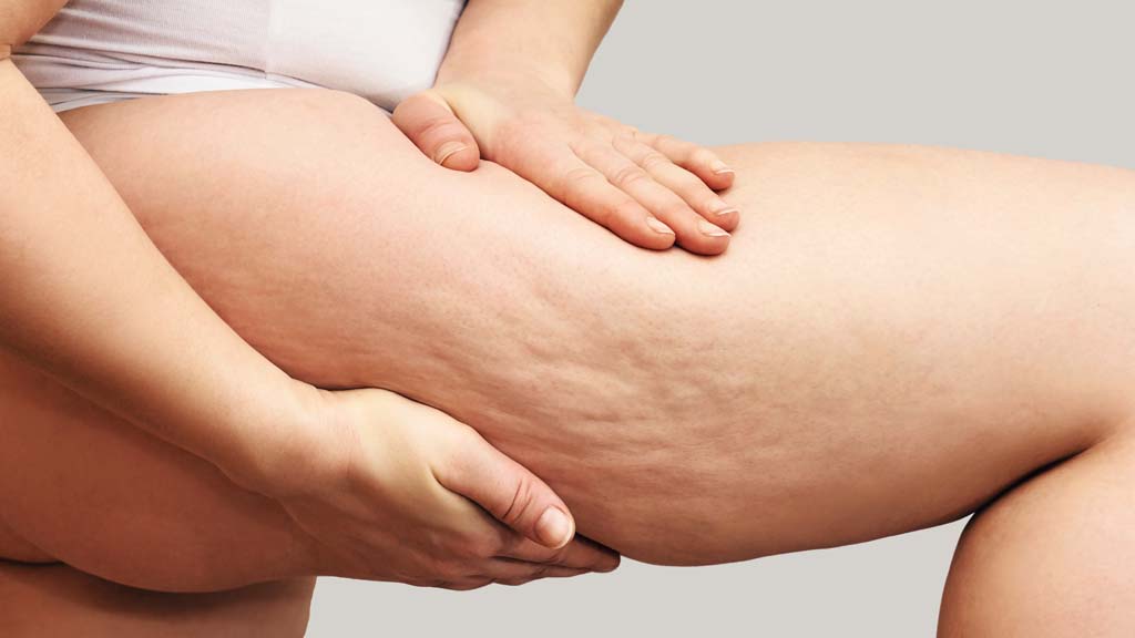 hands squeezing cellulite on a woman's lthigh