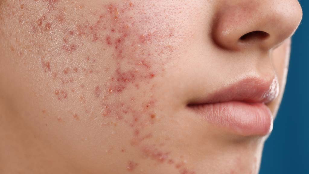 close up a face check showing acne