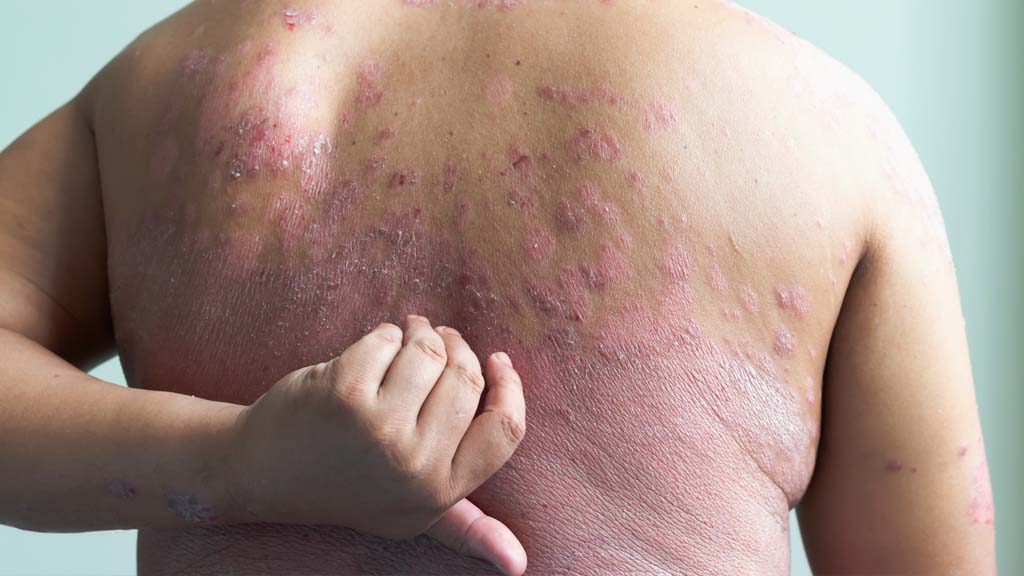 a person is scratching their back that is covered with Psoriasis