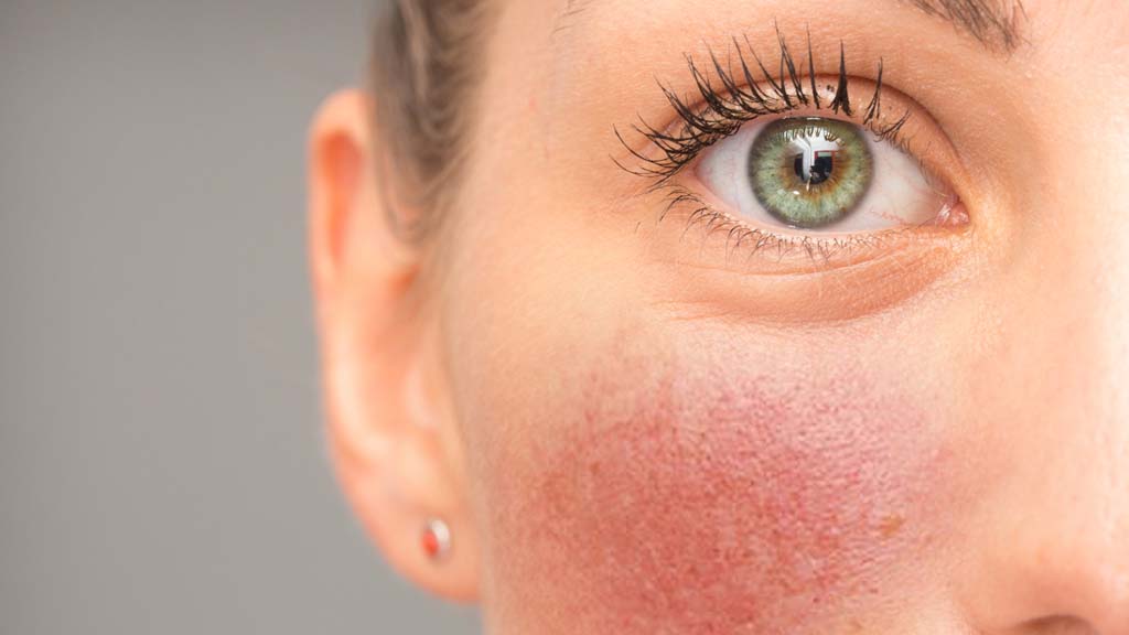 close up of a check showing rosacea 