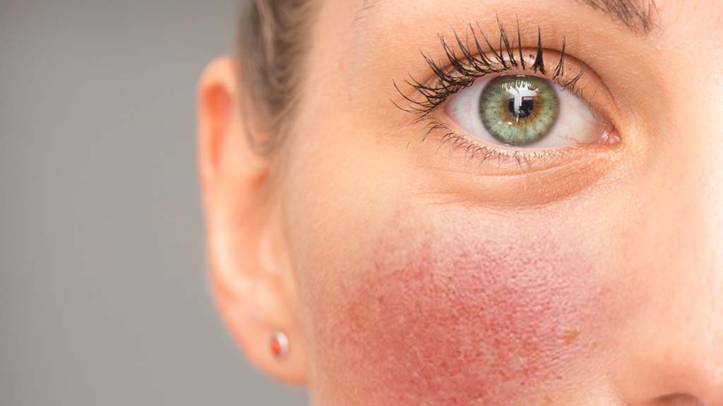 close up of a check showing rosacea