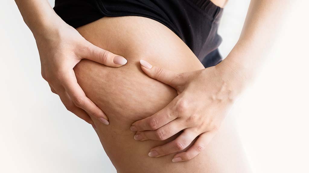 a woman is squeezing her thigh showing cellulite and the areas that need skin rejuvenation